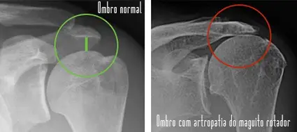 Ombro normal e ombo com artropatia do manguito rotador