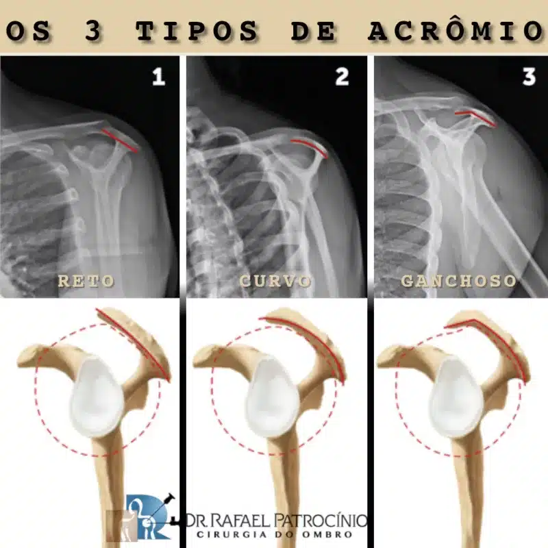 tendinite do ombro e os tipos de acrômio