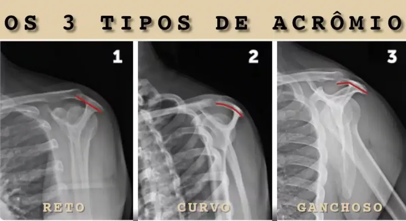 tendinite do ombro e os tipos de acrômio