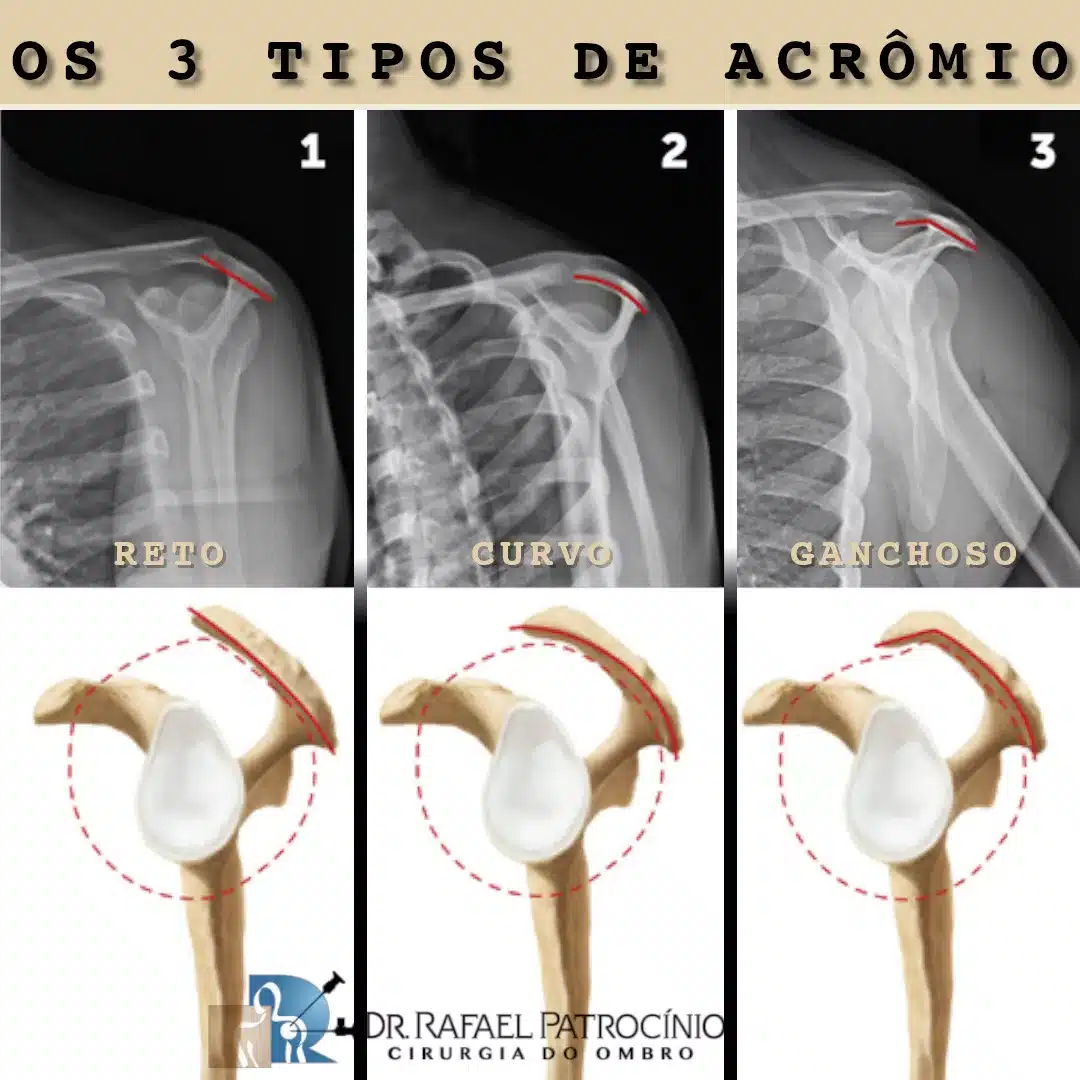 tendinite do ombro