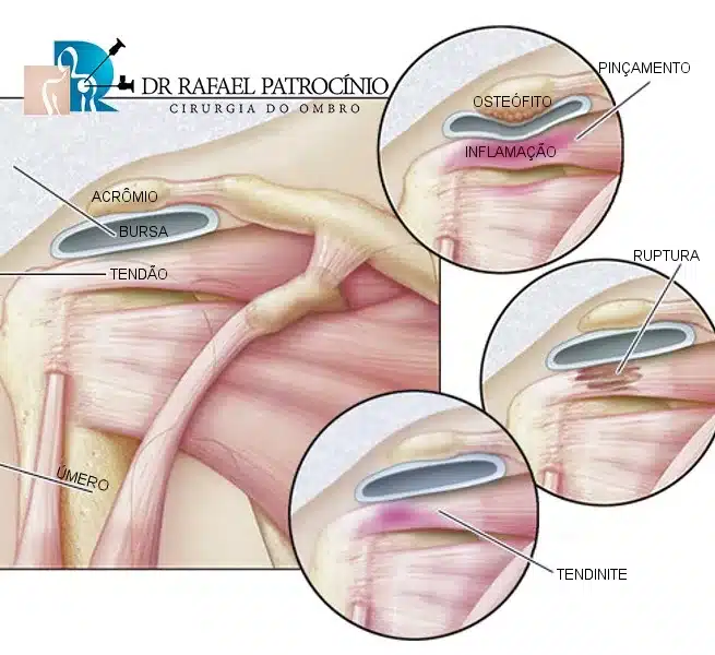 Tendinite do ombro