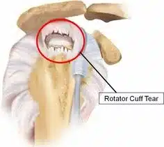 Ruptura transfixante do tendão supraespinhal