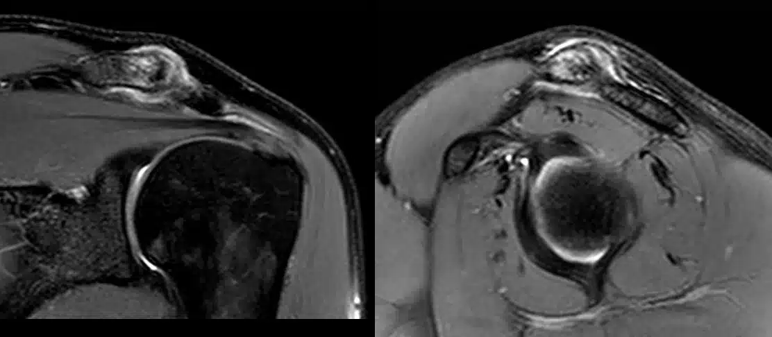 artrose acromioclavicular